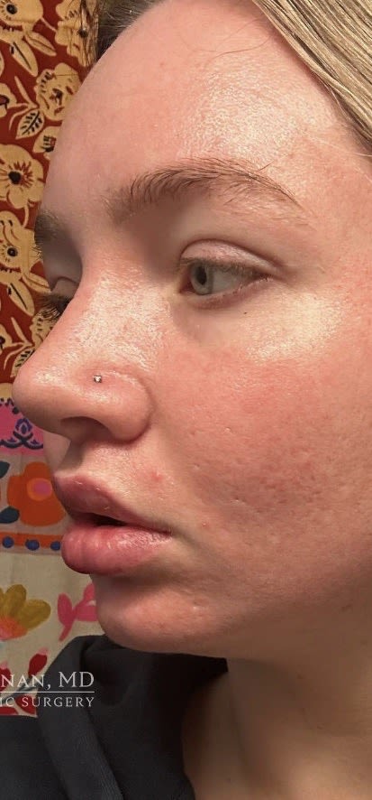 Lip Lift After, Female 23 - 3816