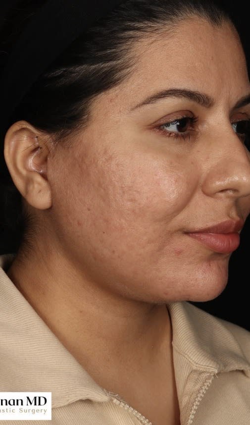 Acne Scar Treatment After, Female 43 - 3820