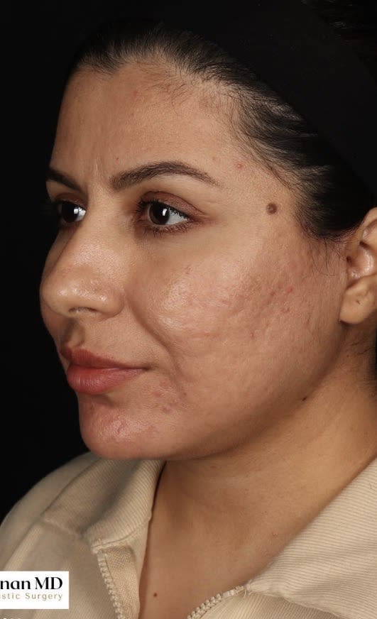 Acne Scar Treatment After, Female 43 - 3821