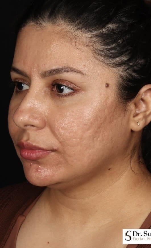 Acne Scar Treatment Before, Female 43 - 3821