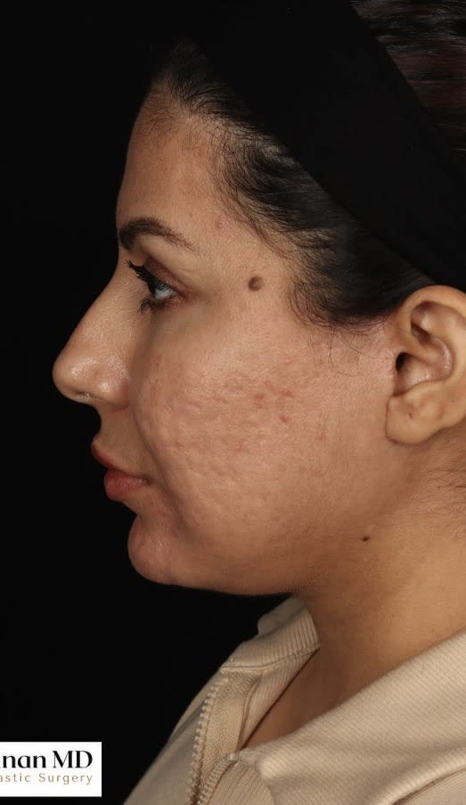 Acne Scar Treatment After, Female 43 - 3822