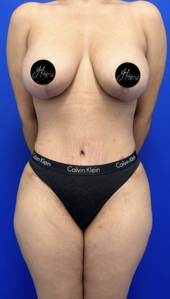 Tummy Tuck (Abdominoplasty) After, Female 45 - 3823