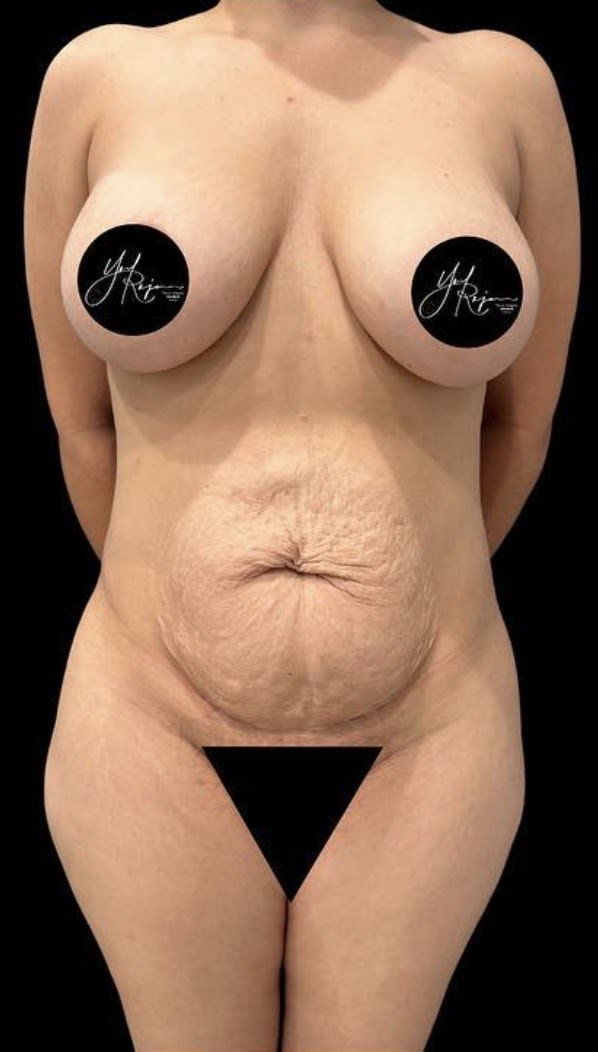 Tummy Tuck (Abdominoplasty) Before, Female 45 - 3823