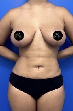 Breast Reduction After, Female 44 - 3824