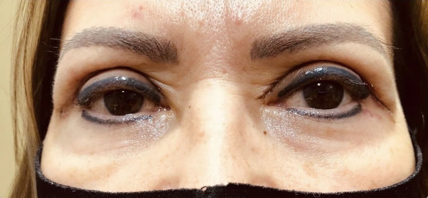 Upper Eyelid Blepharoplasty After, Female 56 - 3827