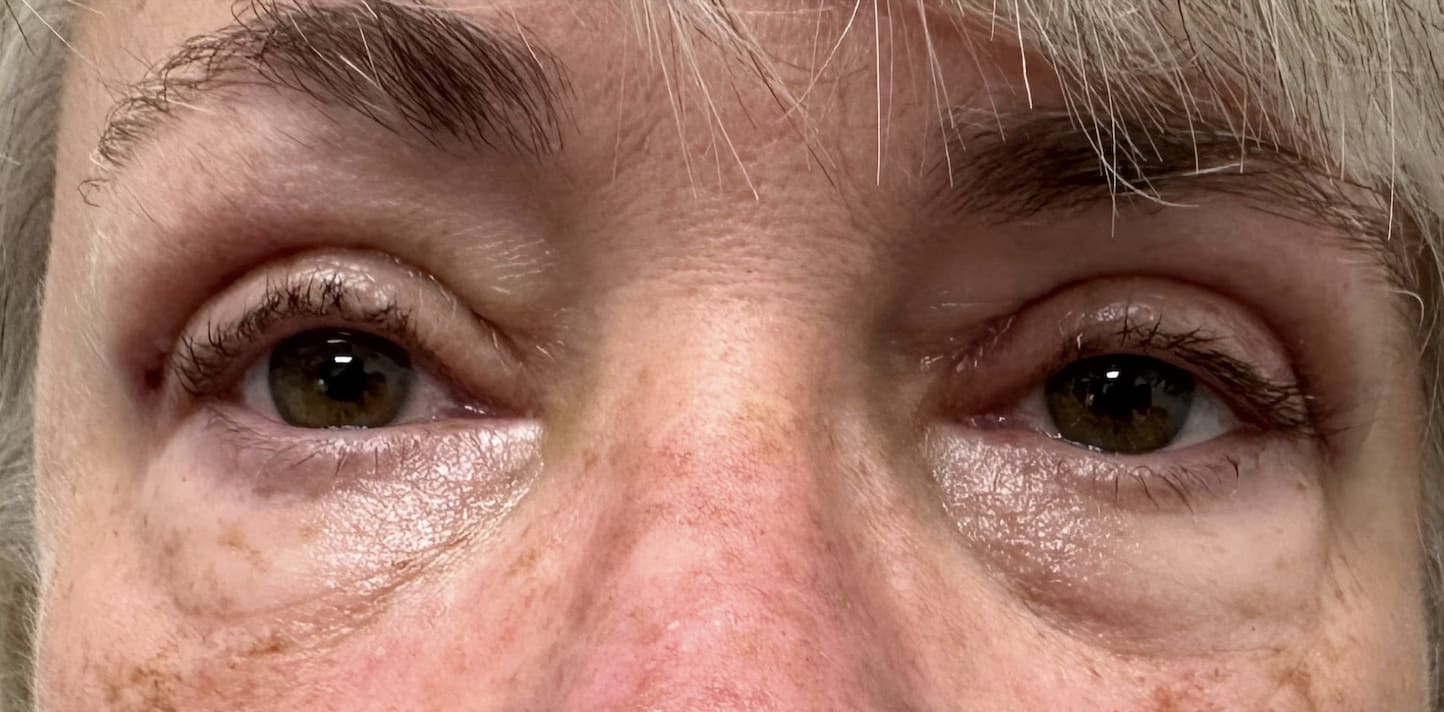 Blepharoplasty After, Female 65 - 3828