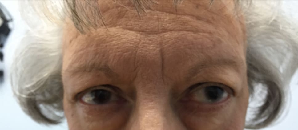 Eyelid Correction Solutions Before, Female 68 - 3829