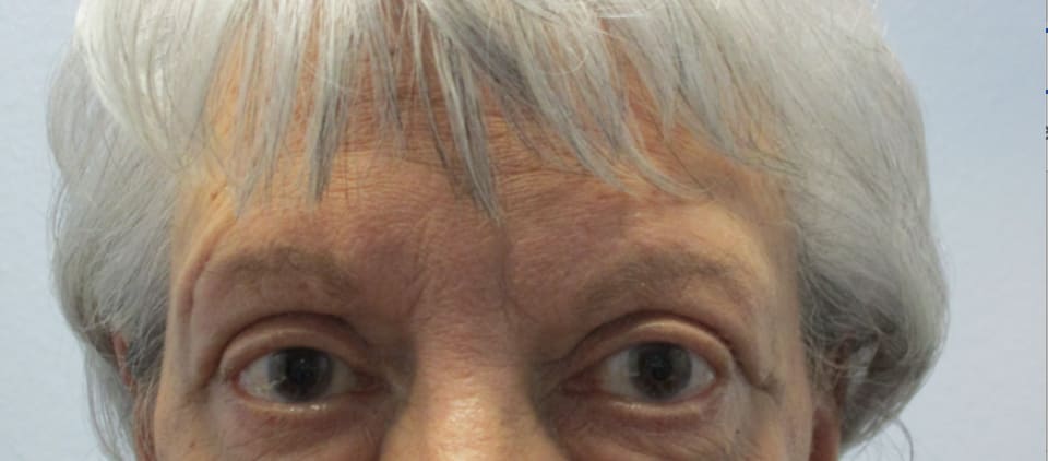 Eyelid Correction Solutions After, Female 68 - 3829