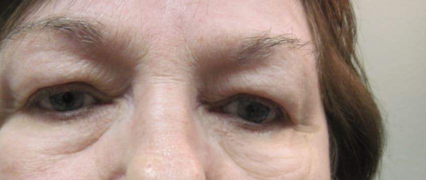 Upper Eyelid Blepharoplasty Before, Female 58 - 3837
