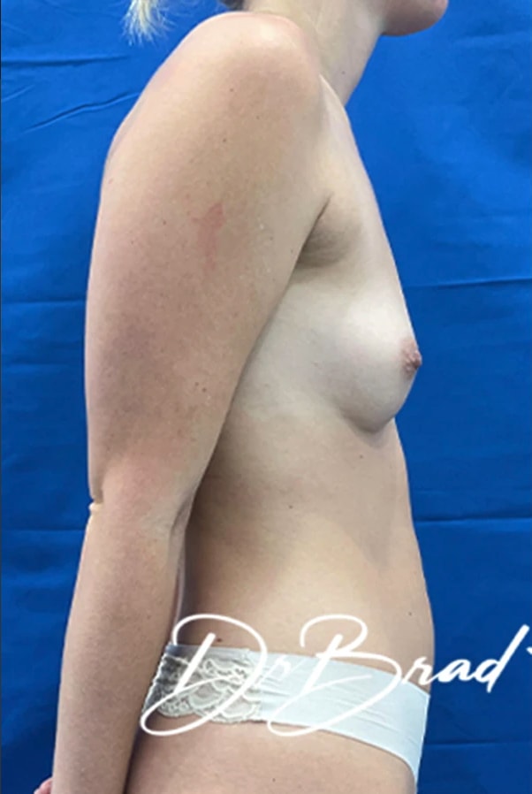 Breast Augmentation with Fat Transfer Before, Female 28 - 3840