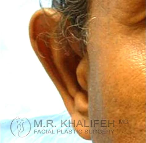 Otoplasty Before, Male 57 - 3842