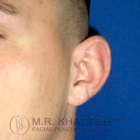 Otoplasty Before, Male 29 - 3843