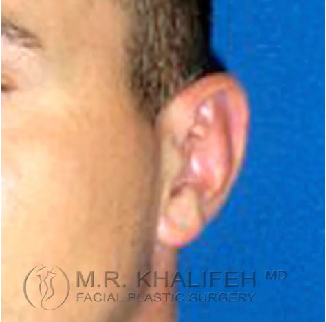 Otoplasty After, Male 29 - 3843