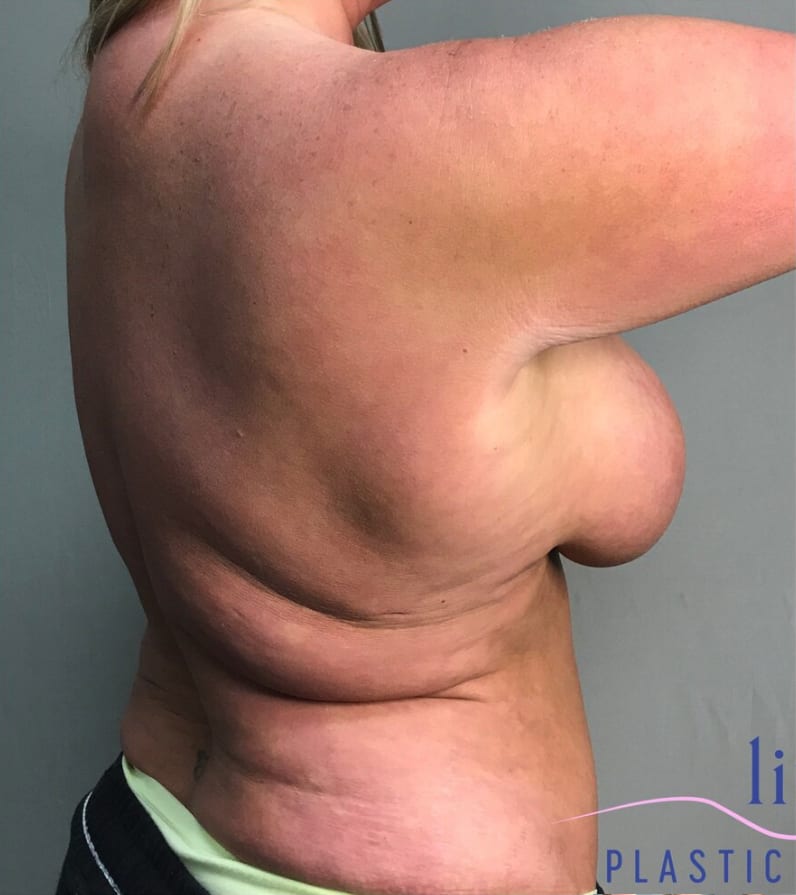 Body Contouring Solutions Before, Female 54 - 3878