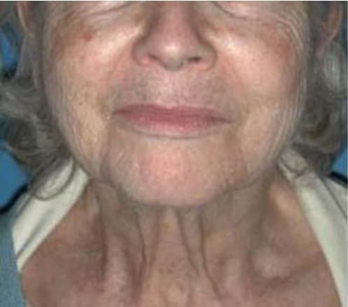 Neck Lift Before, Female 69 - 3881