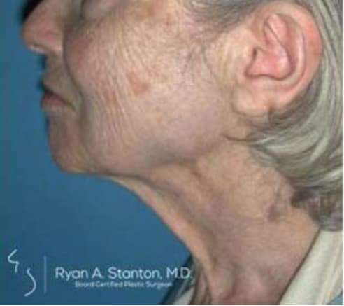 Neck Lift Before, Female 69 - 3882
