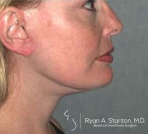 Neck Lift After, Female 47 - 3883