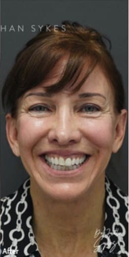 Lip Lift After, Female 63 - 3884