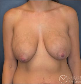 Breast Augmentation with Implants Before, Female 28 - 3854