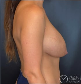 Breast Augmentation with Implants Before, Female 28 - 3856