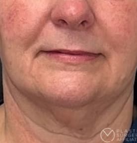 Lip Lift Before, Female 54 - 3857