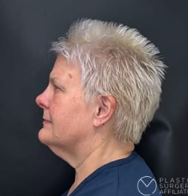 Neck Lift Before, Female 54 - 3858