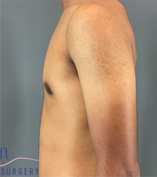 Male Breast Reduction (Gynecomastia Surgery) After, Male 18 - 3867