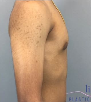 Male Breast Reduction (Gynecomastia Surgery) Before, Male 18 - 3871