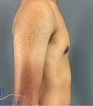 Male Breast Reduction (Gynecomastia Surgery) After, Male 18 - 3871