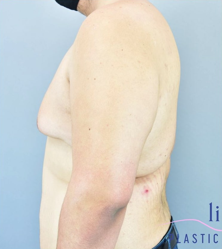 Male Breast Reduction (Gynecomastia Surgery) Before, Male 20 - 3872