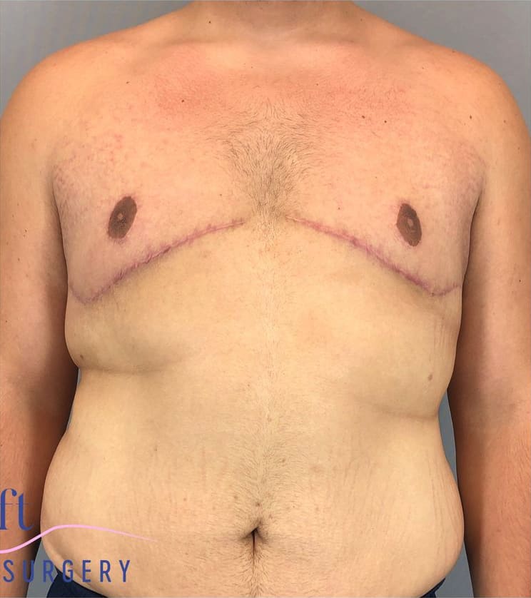 Male Breast Reduction (Gynecomastia Surgery) After, Male 20 - 3874