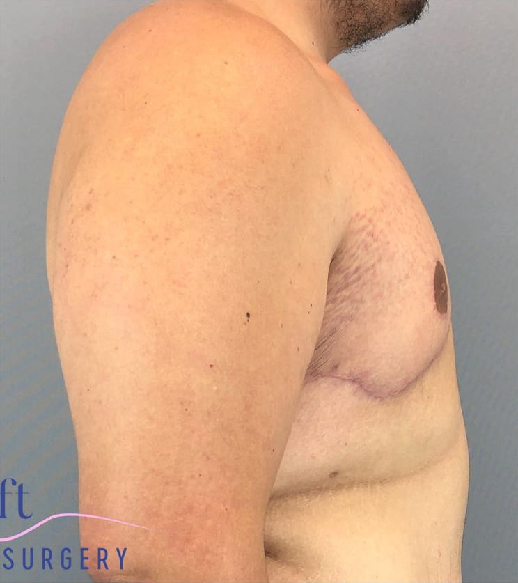 Male Breast Reduction (Gynecomastia Surgery) After, Male 20 - 3876