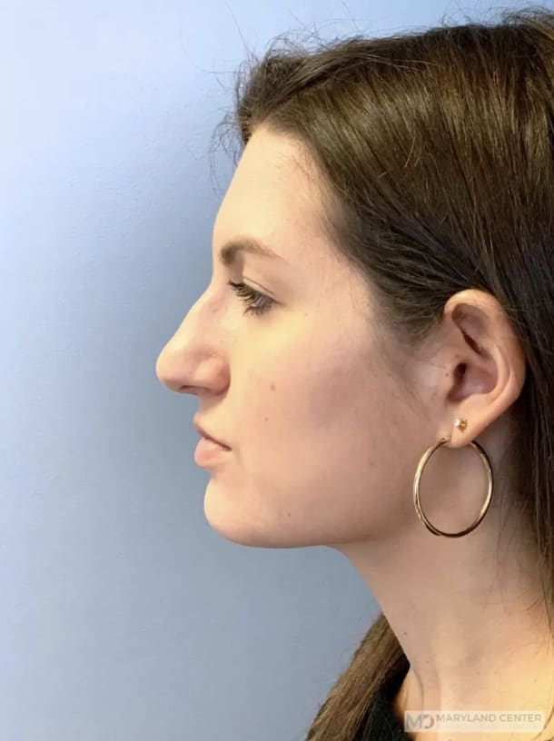 Rhinoplasty Before, Female 33 - 3893