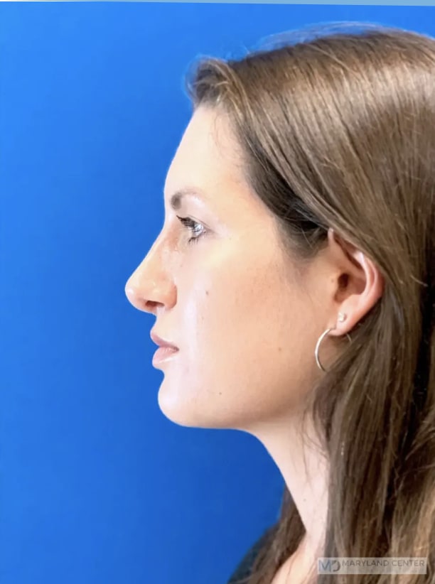 Rhinoplasty After, Female 33 - 3893