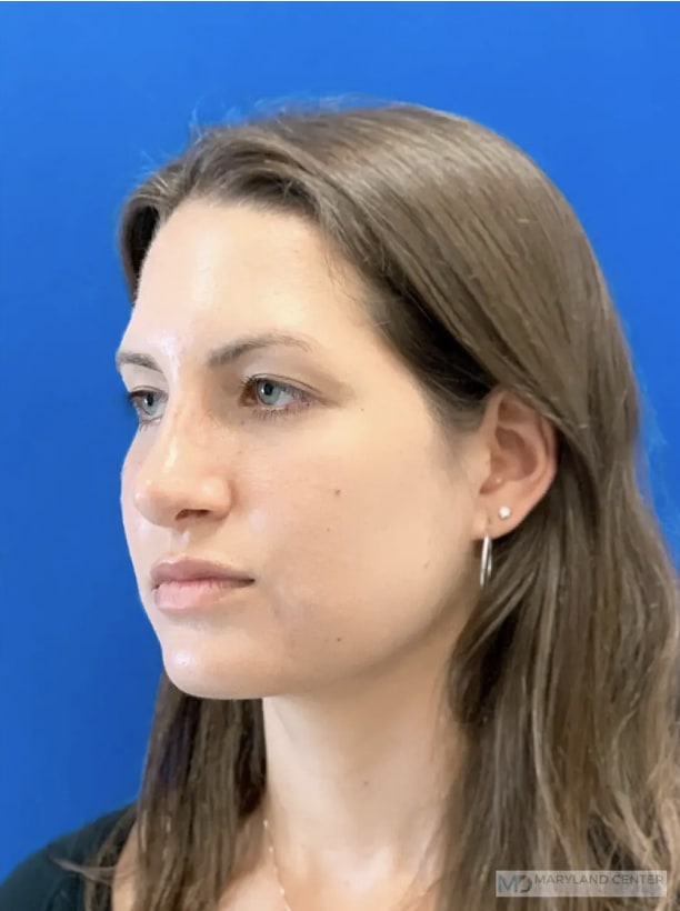 Rhinoplasty After, Female 33 - 3894