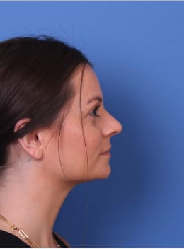 Rhinoplasty After, Female 28 - 3891