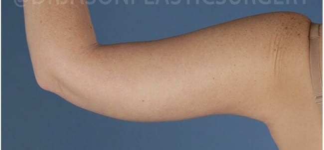 Arm Lift After, Female 35 - 3896