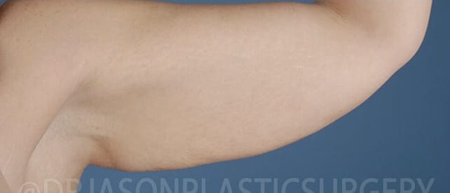 Arm Lift Before, Female 43 - 3897