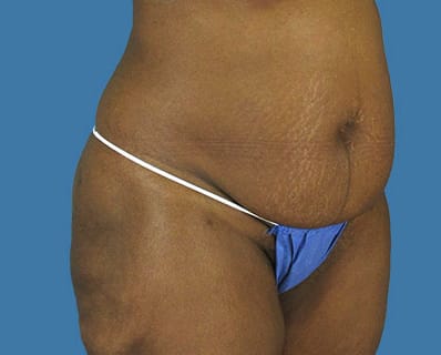 Liposuction Before, Female 37 - 3954