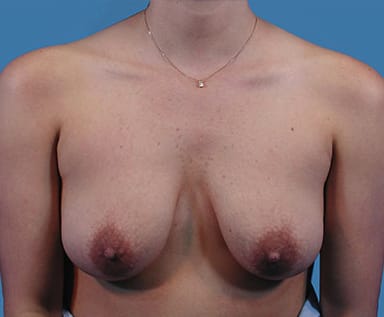 Breast Augmentation (Augmentation Mammaplasty) Before, Female 33 - 3955