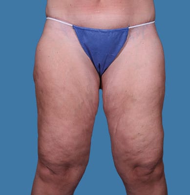 Thigh Lift Before, Female 46 - 3956