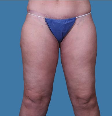 Thigh Lift After, Female 46 - 3956