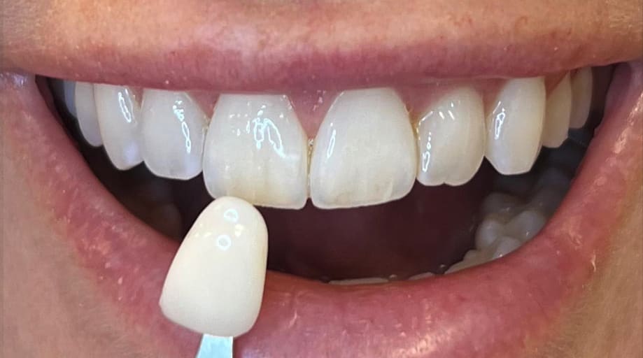 Teeth Whitening After, Female 30 - 3980