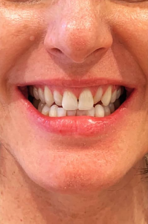 Dental Veneers Before, Female 31 - 3983