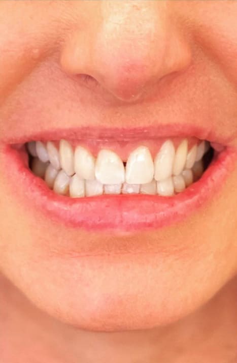 Dental Veneers After, Female 31 - 3983