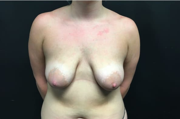 Breast Lift Before, Female 37 - 3985
