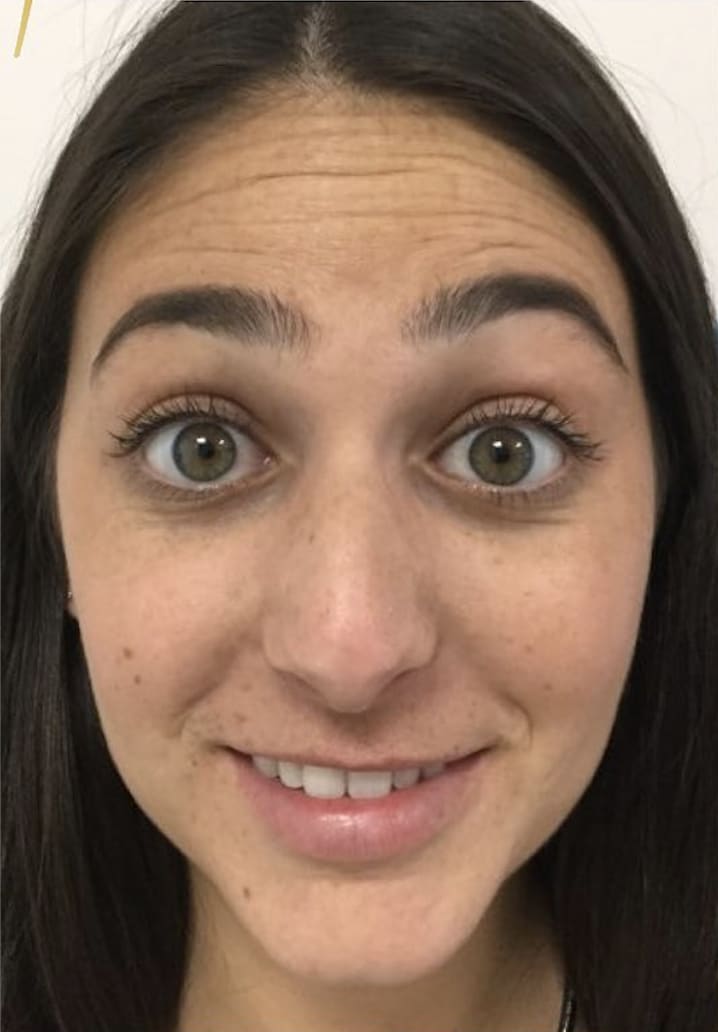 Botox Before, Female 26 - 3989