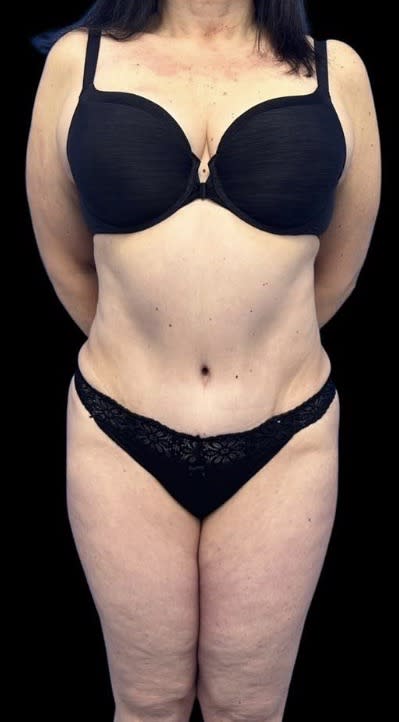 Abdominoplasty After, Female 61 - 4017