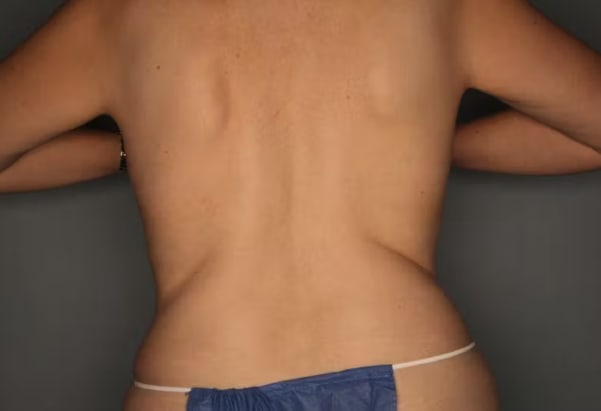 CoolSculpting® After, Female 39 - 4032