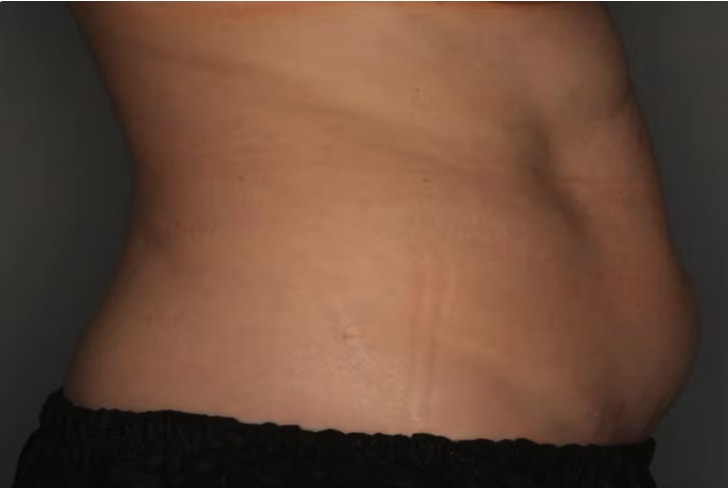 CoolSculpting® Before, Female 41 - 4034